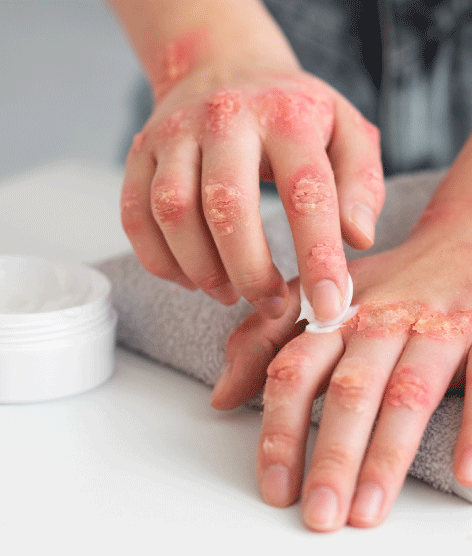 2-sobre-la-psoriasis-accesibles